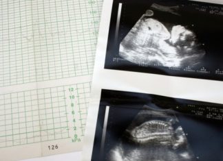 heartbeat bill