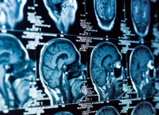 brain ct scan